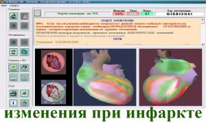 Приклади портрета серця, ІХС, зміни при інфаркті міокарда