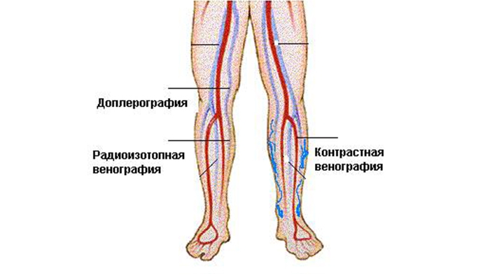 Тромбоз глубоких вен нижних мкб. Воспаление вен нижних конечностей. Ультразвуковая анатомия вен нижних конечностей.