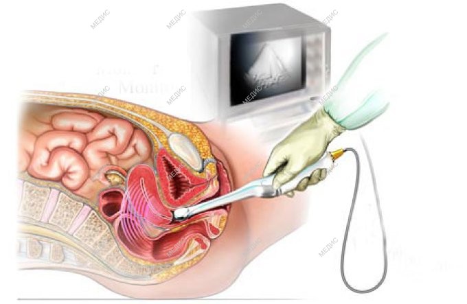 Гинекологическое обследование состояния матки